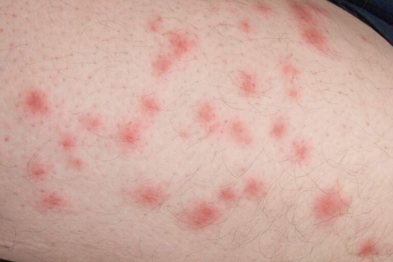 What Do Bed Bug Bites Look Like: Key Characteristics and Treatment Tips