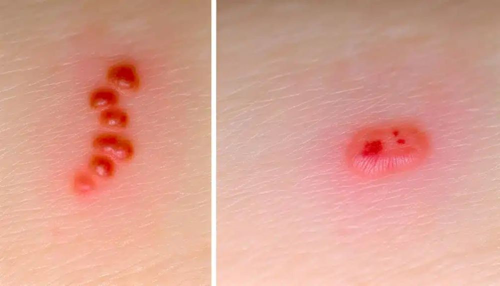 Flea Bites Vs Bed Bug Bites